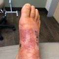 Understanding Lisfranc Injuries: Signs, Symptoms, and Treatment