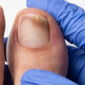 Your Complete Guide to Diabetic Toenails: What Do They Look Like and How to Address Them