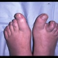 Understanding Psoriatic Arthritis and Foot Pain