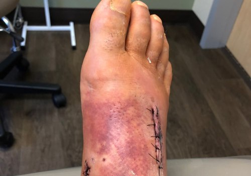 Understanding Lisfranc Injuries: Signs, Symptoms, and Treatment