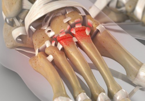 Understanding Lisfranc Injuries: What You Need to Know