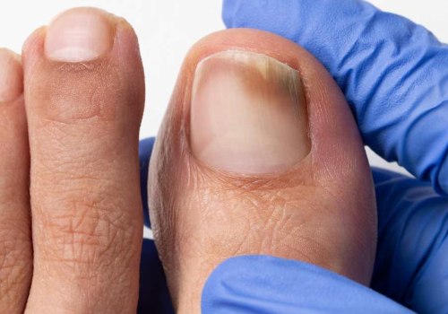 Your Complete Guide to Diabetic Toenails: What Do They Look Like and How to Address Them